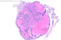 Cistoadenolinfoma (tumor de Warthin) de una parótida.