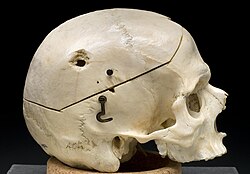 جمجمة ذكر تظهر جرح دخول رصاصة في العظم الجداري، 1950