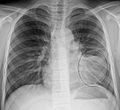 AP CXR, 왼쪽 폐에 폐렴이 있다.