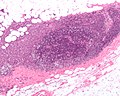 Micrografia che mostra un linfonodo invaso da un carcinoma duttale.