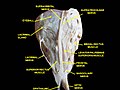 Vue supérieure d'une dissection de l'orbite. Le nerf frontal est visible en se ramifiant dans les nerfs supratrochléaire et supraorbitaire.