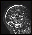 MR-Angiographie der venösen Strombahnen