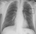 Rendgenska snimka raka pluća