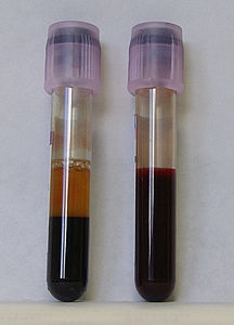Du tuboj de sango kun EDTA-antikoagulantoj. Maldekstra tubo: post starigo, la eritrocitoj setlis ĉe la fundo de la tubo. Dekstra tubo: enhavas libere kolektitan sangon.