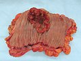 มะเร็งลำไส้ใหญ่ (อังกฤษ: colorectal carcinoma) ที่รุกราน (กลางบน) ในตัวอย่างเนื้อเยื่อลำใส้ใหญ่
