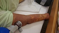 Пацієнт з септичним шоком і мікротромбозами в шкірі