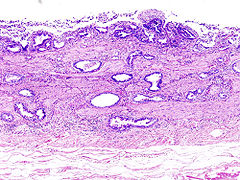 Câncer biliar descoberto após uma colecistectomia