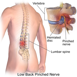 Lumbar disc herniation