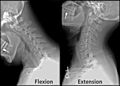頸椎の屈曲・伸展のX線画像。