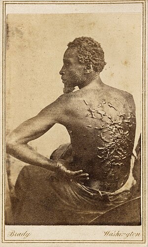 תצלום צלקות קלואיד על גבו של העבד גורדון כתוצאה מהצלפות.