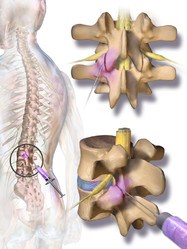 Facet joint injection.