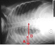 Et røntgenbillede, der viser en horisontalt liggende brystkasse. Det nederste sorte område, som er højre lunge, er mindre og har et mere hvidt område nedenunder, der er en pulmonal effusion. Røde pile angiver størrelsen på disse.