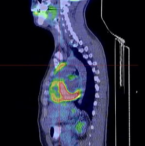 Aspect d'un thymome en TEP scanner avec une discrète hyperfixation.