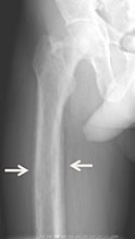 Projectional radiography ("X-ray") of periosteal reaction.[18]