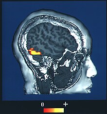 A side-on image of an fMRI scan of a human brain.