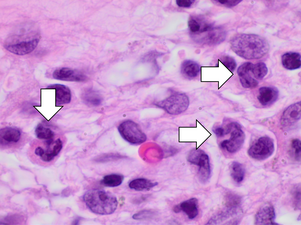 Acute inflammation characterized by neutrophils.