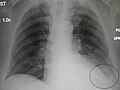 AP CXR, 왼쪽에 폐렴이 있다.