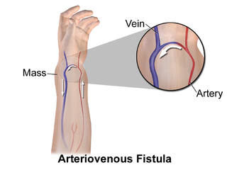 Arteriovenous fistula.