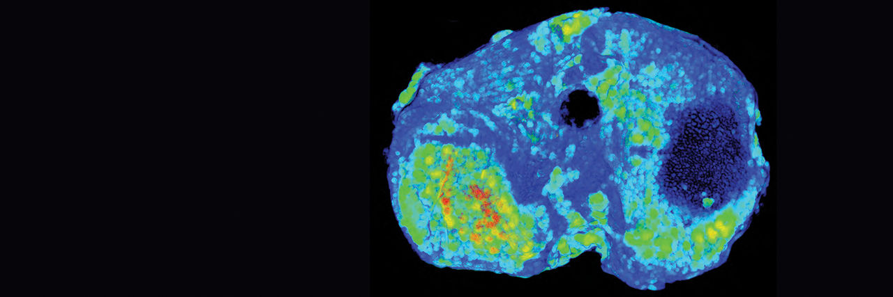 Color-coded model of osteochondral thickness of an osteoarthritis sample