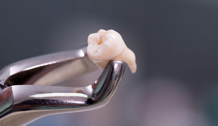 Photo of an extracted tooth