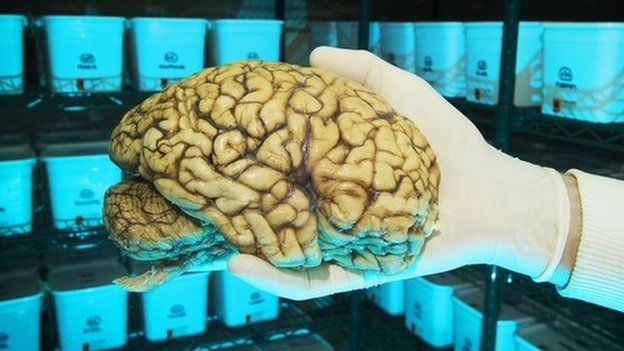 Human brain stored at research lab