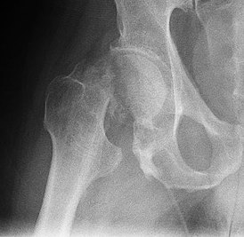 Рентгенограмма, демонстрирующая перелом шейки бедра