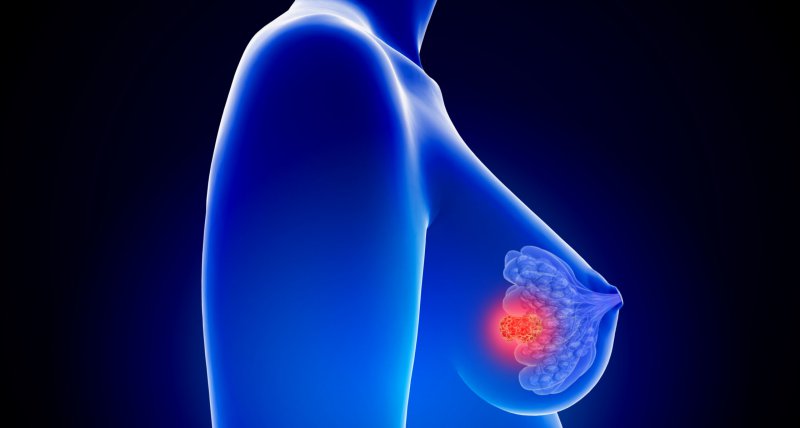 HER2-low Brustkrebs: Trastuzumab-Deruxtecan verbessert PFS ohne vorherige Chemotherapie