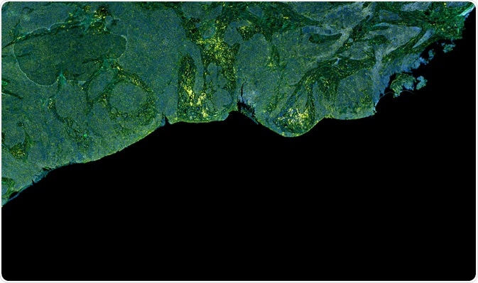 fluorescence-labeled tumor