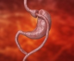 Study suggests gastric bypass can reduce cardiovascular disease risk, irrespective of weight loss