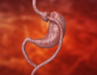 Study suggests gastric bypass can reduce cardiovascular disease risk, irrespective of weight loss