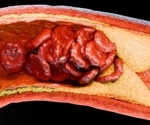 Coronary atherosclerosis prevalent even in low-risk adults with normal cholesterol levels