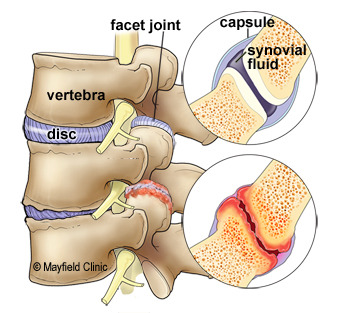 Wear and tear to the disc and facet joint can cause arthritic pain, swelling and stiffness