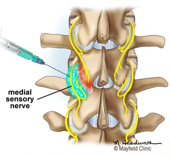 Anesthetic is injected along the nerve to block pain