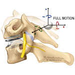 Arthroplasty, cervical