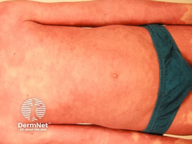Confluent redness affecting more than 80% of the body – erythrodermic psoriasis