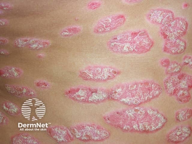 Well demarcated plaques with silvery scale in chronic plaque psoriasis