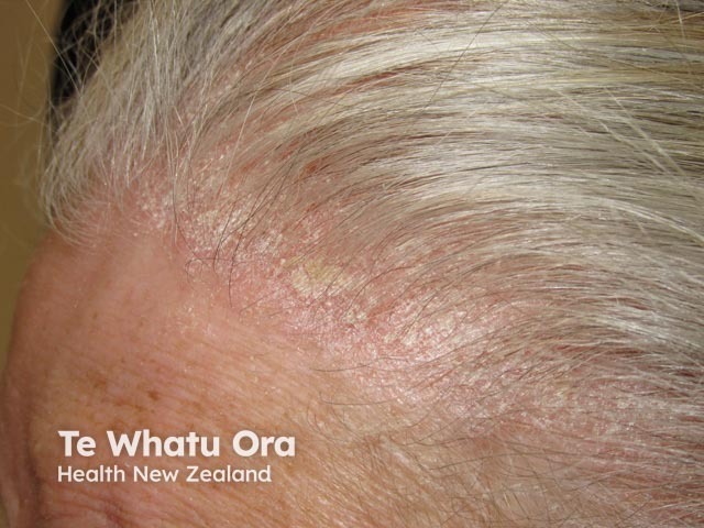 Scalp psoriasis often extends beyond the hair line