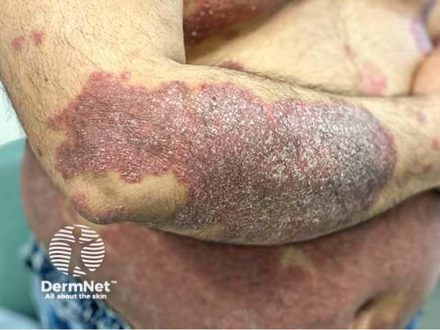 Chronic plaque psoriasis in skin of colour