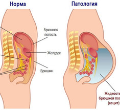 Водянка: Почему в теле скапливается лишняя вода и как ее вывести