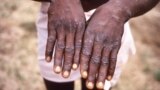 This 1997 image provided by the CDC during an investigation into an outbreak of monkeypox, which took place in the Democratic Republic of the Congo (DRC), formerly Zaire, and depicts the dorsal surfaces of the hands of a monkeypox case patient.
