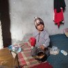Двухлетний житель Йемена Бадель истощен от недоедания. Фото ООН