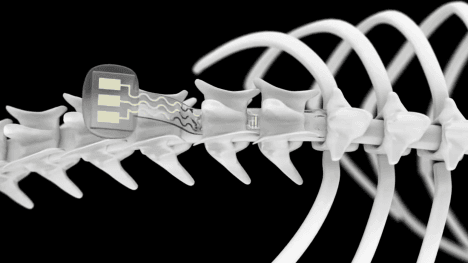 Náhledový obrázek - Páteřní implantát léčí míchu pomocí elektrických impulzů. Ochrnutí pacienti by díky němu mohli opět chodit
