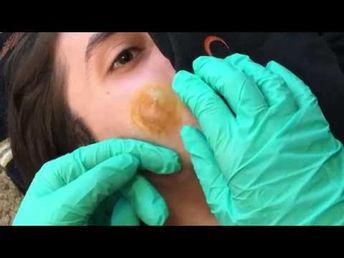 Youtube, Videos, Get Rid Of Blackheads, Pimple Extraction, Pimple Popping, Huge Pimple, Popping Pimples Videos Youtube, Covering Acne, Remove Acne