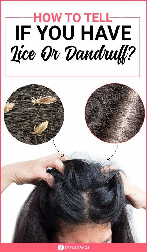 Do youhave an itchy scalp? Are you seeing white dots on the hair? Here are the differences between dandruff and lice, their causes, and prevention tips. What To Do If You Have Dandruff, How To Deal With Dandruff, Ways To Get Rid Of Dandruff, How To Remove Lice From Hair, How To Get Rid Of Dandruff Fast At Home, How To Remove Dandruff From Scalp, Lice Remedies How To Get Rid Of, Scalp Scrub For Dandruff, Dandruff Remedy Severe