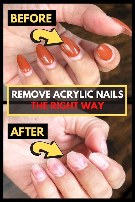 Soak Off Acrylic Nails, Remove Acrylic Nails At Home, Remove Fake Nails, Take Off Acrylic Nails, Nails After Acrylics, Solar Nails, Remove Acrylics, Gel Nail Removal, Remove Acrylic Nails