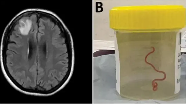 Brain scan and di 'happily moving' worm inside specimen jar