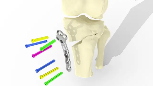 Di implant dey preserve di existing joint and dem fit use am for earlier stage of arthritis, bifor knee replacement dey needed