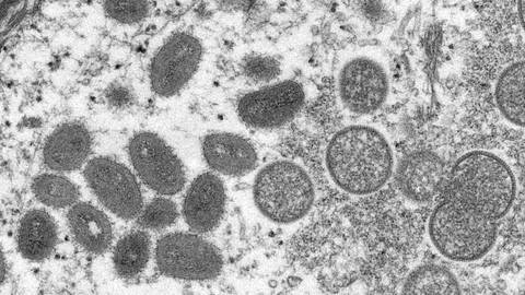 RDC: les soignants annoncent l'augmentation "exponentielle" des cas de "variole du singe"
