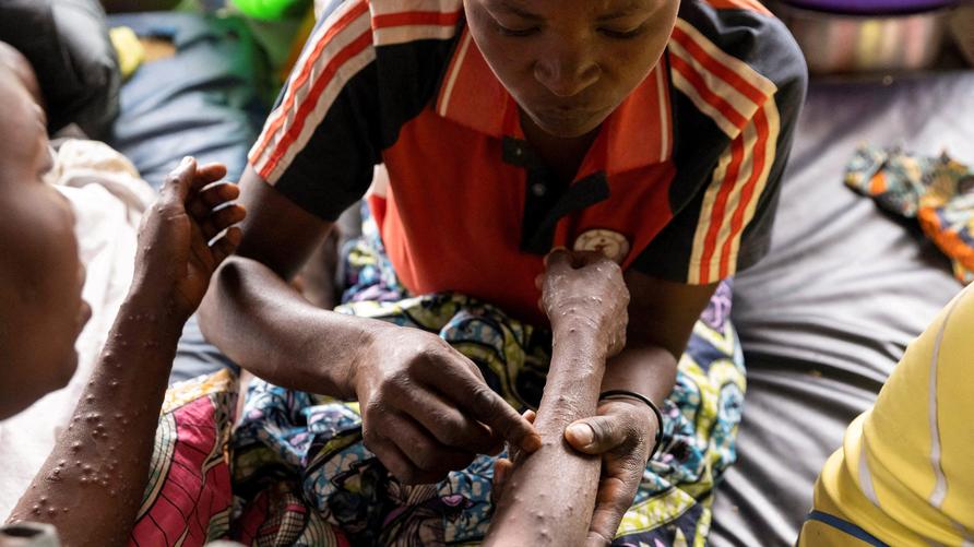 Mpox: FILE PHOTO: Nsimire Nakaziba 34, pricks the rashes on her sister Sifa Mwakasisi, 32, to relieve pain inside a tent where she is undergoing treatment against mpox at the Kavumu hospital in Kabare territory, South Kivu province of the Democratic Republic of Congo, August 29, 2024. REUTERS/Arlette Bashizi//File Photo