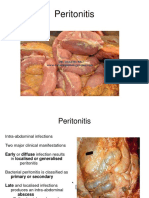 Peritonitis